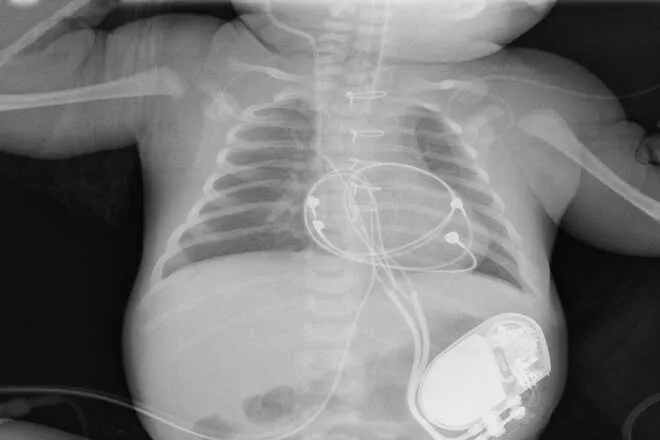  Новорожденному имплантировали электрокардиостимулятор сердца